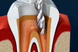 🦷 مراحل عصب‌کشی دندان (+ویدئو)
