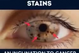 لکه‌های روی عنبیه چشم ، چه چیزی درمورد سلامتتان میگوید ؟  